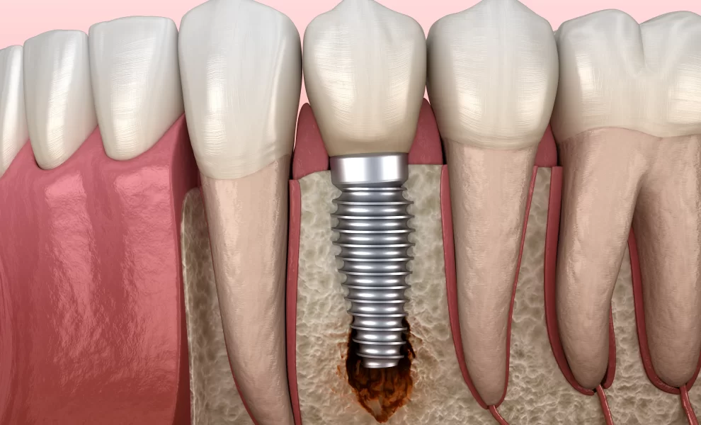 İmplant Nedir? Kimlere Ve Nasıl Uygulanır?