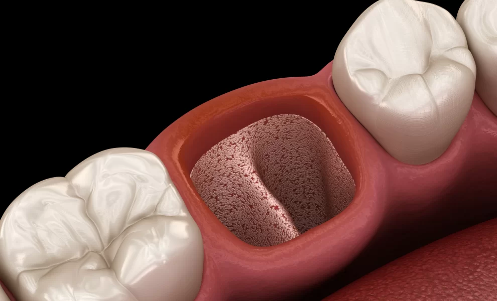 Diş Çekimi İle Aynı Gün İmplant Uygulaması Yapılabilir Mi?