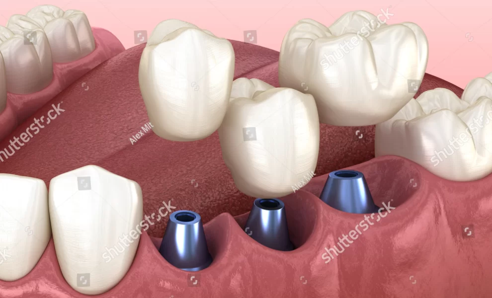 Diş İmplantı Kimlere Uygulanamaz?