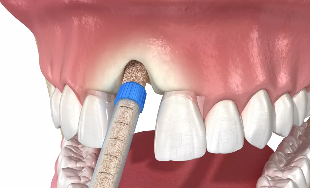 Bone Grafting For Dental Implants