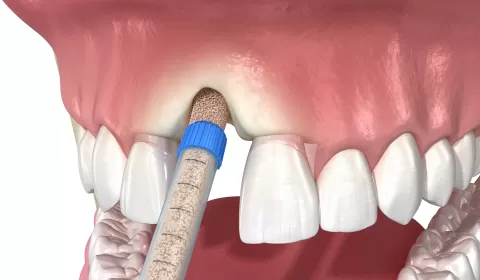Bone Grafting For Dental Implants