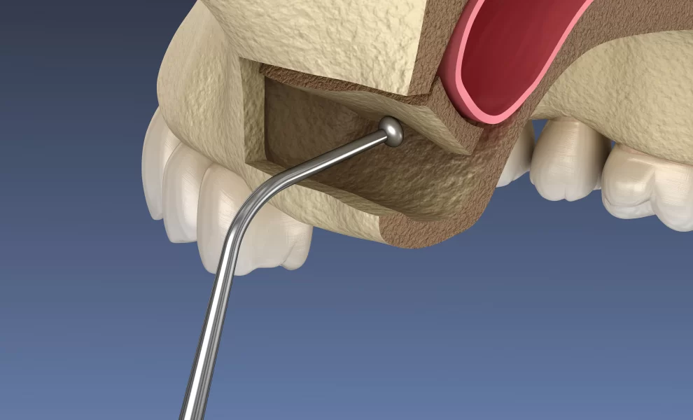 Sinus Lift With Upper Jaw İmplants
