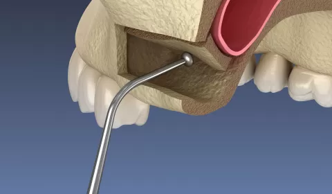 Sinus Lift With Upper Jaw İmplants