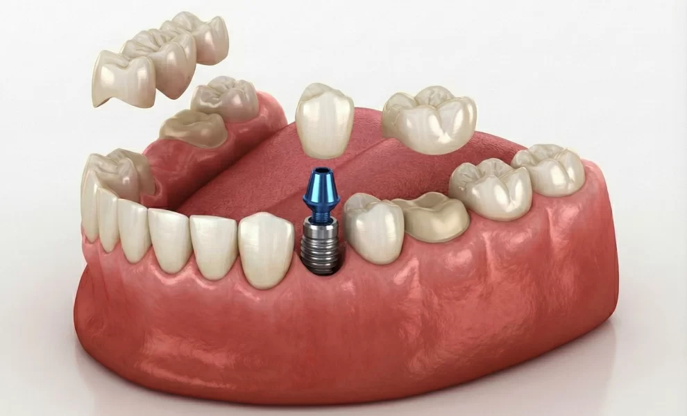 Implant Or Brıdge? Whıch Is The Rıght Treatment For A Mıssıng Tooth?