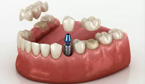 Implant Or Brıdge? Whıch Is The Rıght Treatment For A Mıssıng Tooth?