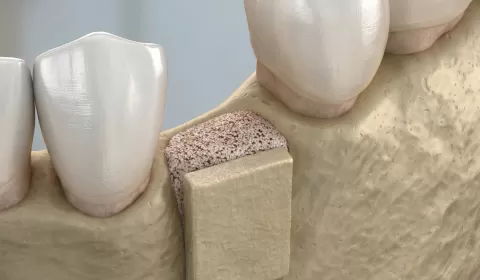 Kemik Grefti Nedir? Ne İşe Yarar?