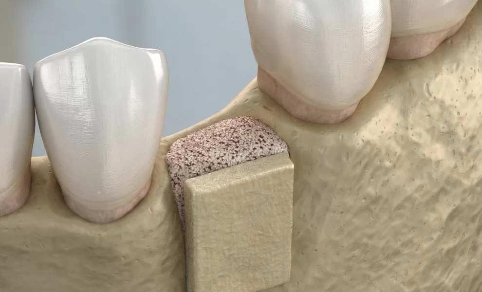 What Is A Bone Graft? How Does It Work?