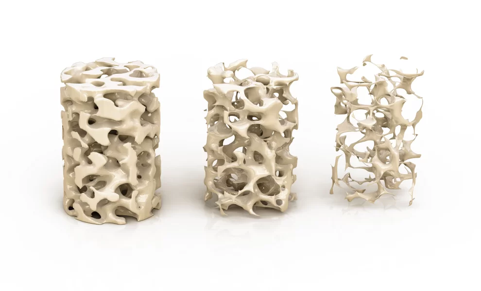 Kemik Erimesi (Osteoporoz) Olanlarda İmplant Yapılabilir Mi ?