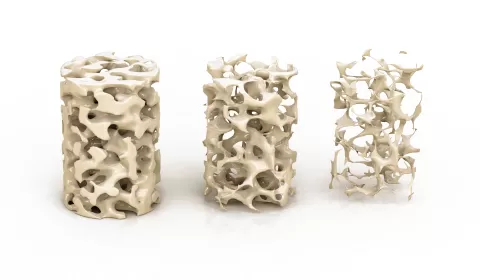 Can Implants Be Placed İn Patients With Osteoporosis?