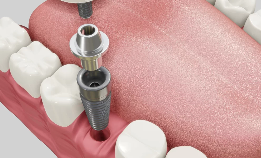 The Stages Of Dental Implant Treatment