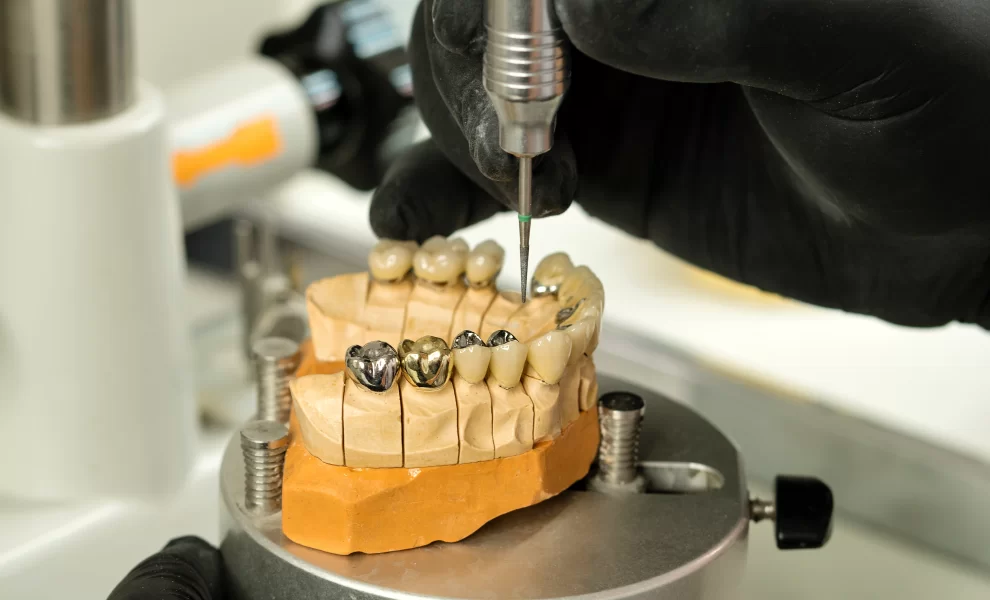 Eksik Dişlere İmplant Mı, Köprü Mü? Yapılmalı ?