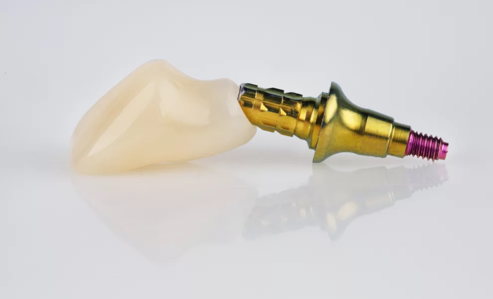 Dental Implant Terminology