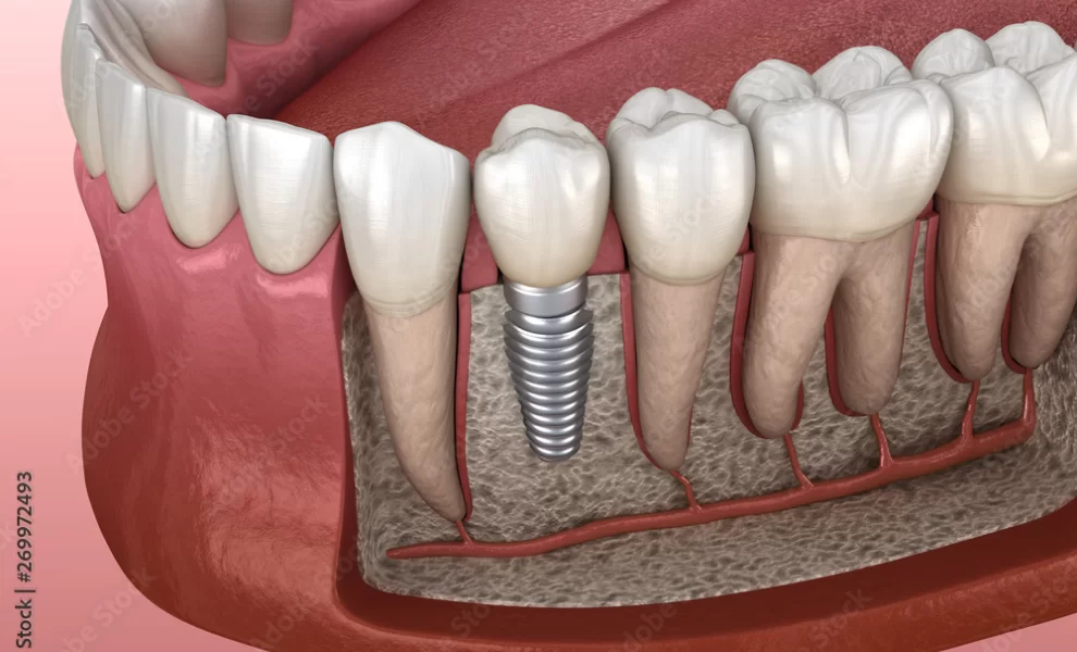Long-term Denture Use Vs. Implants: What Happens To Your Bone?