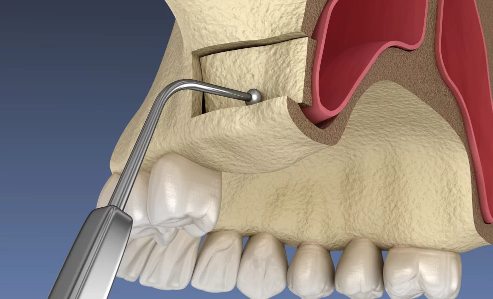 Kemik Tozu Ve Sinüs Lifting Nedir?