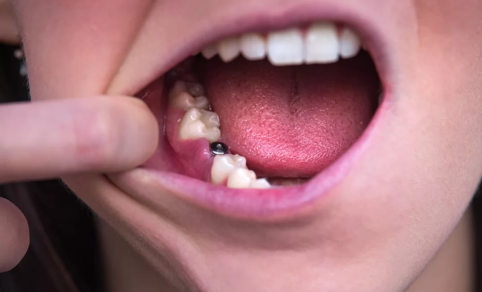 Tek Diş Eksikliğinde İmplant: Komşu Dişlere Zarar Verir Mi ?