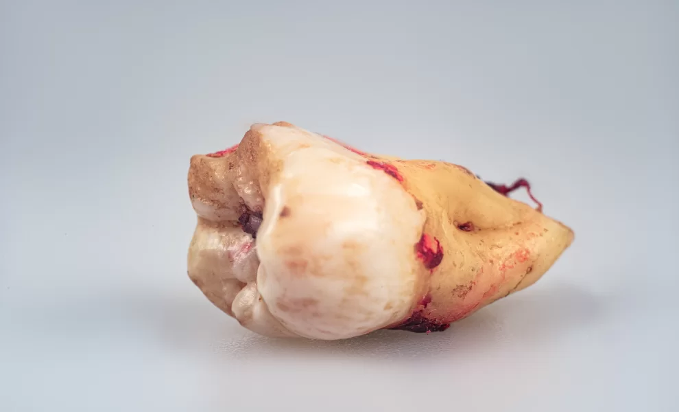 İmplant Neden Bazen Tutmaz?