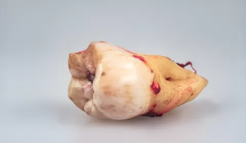 İmplant Neden Bazen Tutmaz?