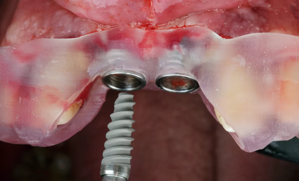 İmplant Kaybını Önleme Yolları