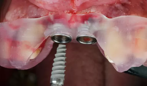 İmplant Kaybını Önleme Yolları