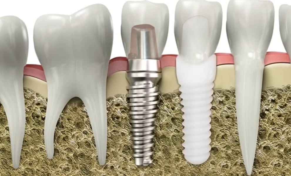 Zirkonyum İmplant Nedir? Gerçekten Metal İçermez Mi?