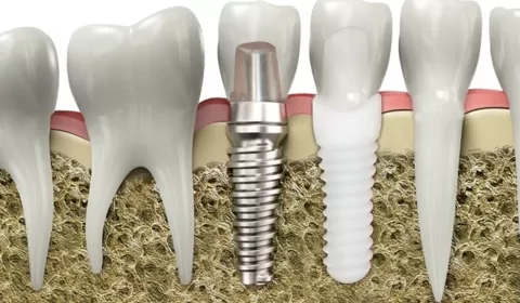Zirkonyum İmplant Nedir? Gerçekten Metal İçermez Mi?