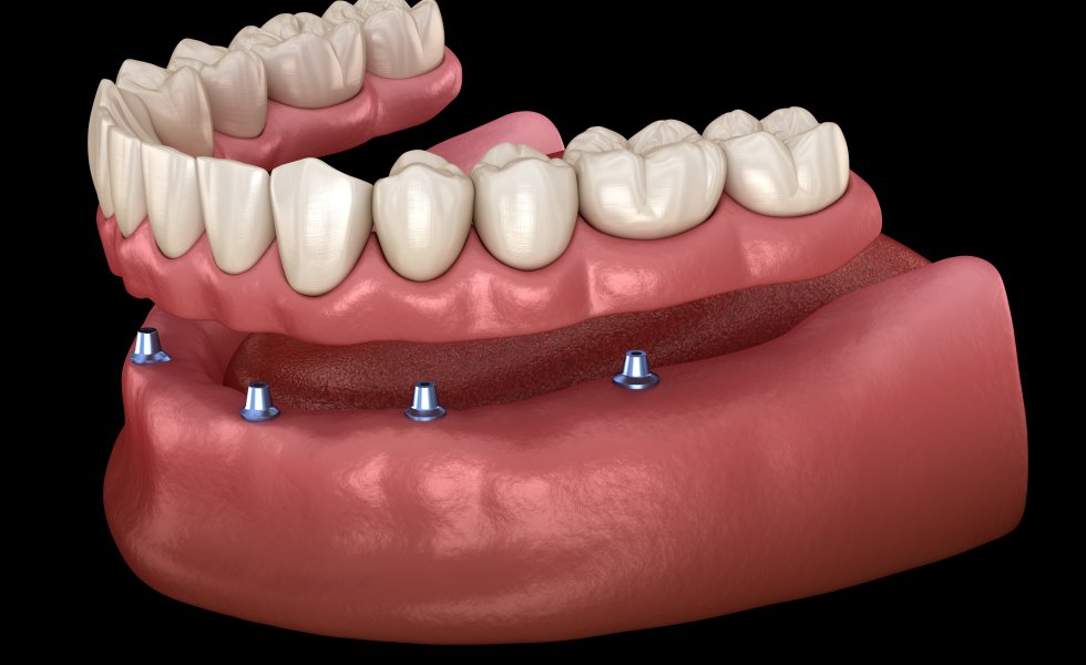 All-on-four İmplant Tedavisi