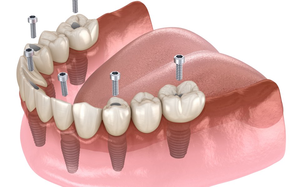 All On Six İmplant Tedavisi