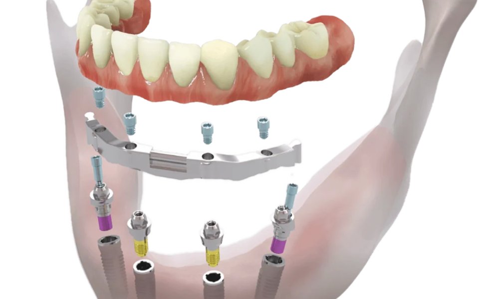 İliak Greft İle İmplant Yapımı