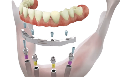 İliak Greft İle İmplant Yapımı