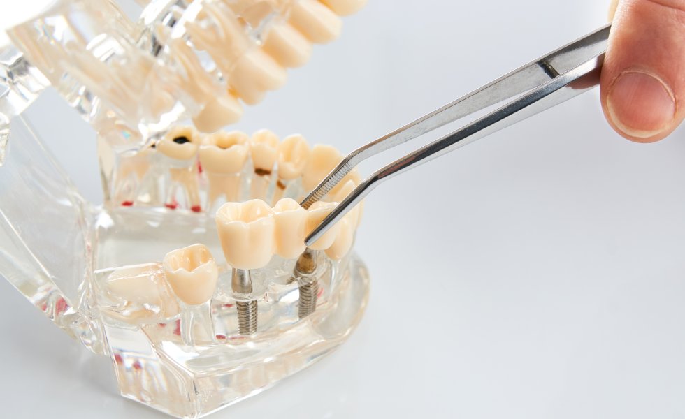 İmplant Destekli Köprü Tedavisi