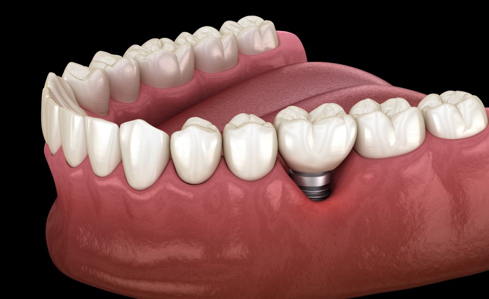 İmplant Neden Düşer ? Peri-implantitis Tedavisi