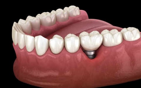 İmplant Neden Düşer ? Peri-implantitis Tedavisi