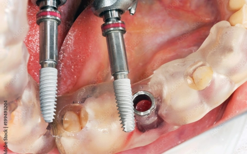 Rehberli İmplant Cerrahisi Tedavisi