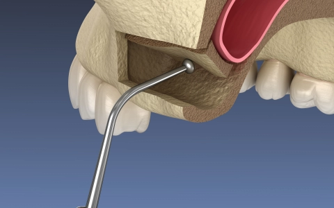 Sinus Lifting Tedavisi