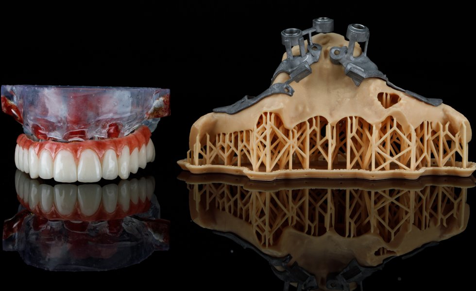 Subperiostal (Kişiye Özel) İmplant Tedavisi