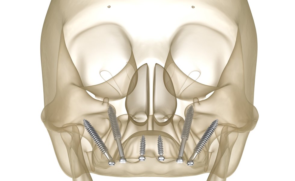 Zigomatik İmplant Tedavisi