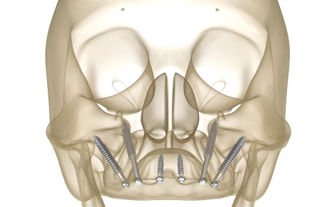 Zigomatik İmplant Tedavisi
